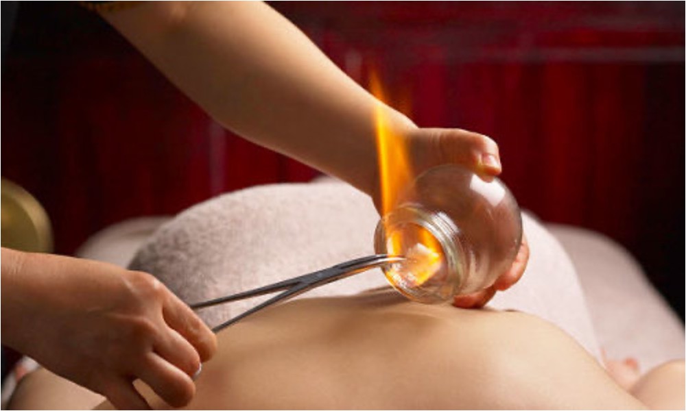 Role of Cupping and Trigger Point Therapy in Acupuncture