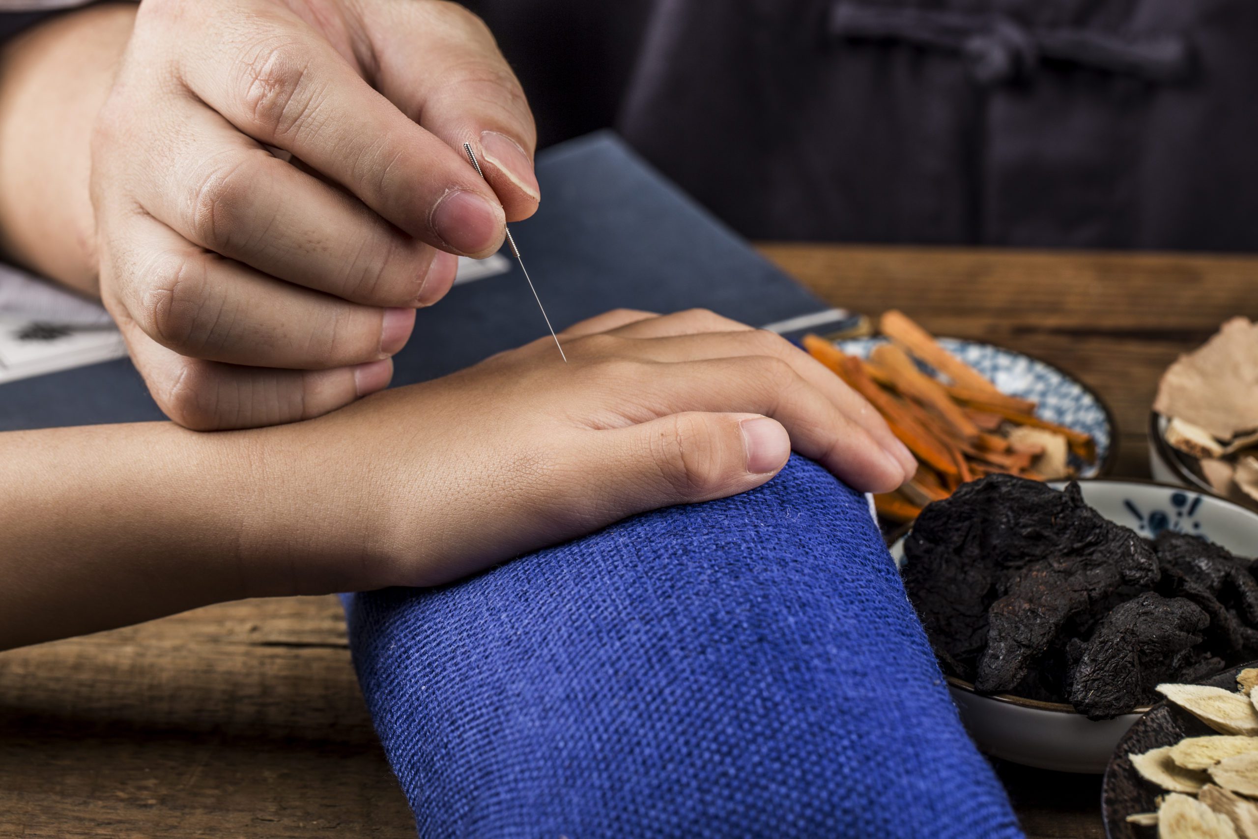 Why Acupuncture Is The Best Natural Alternative Therapy For You