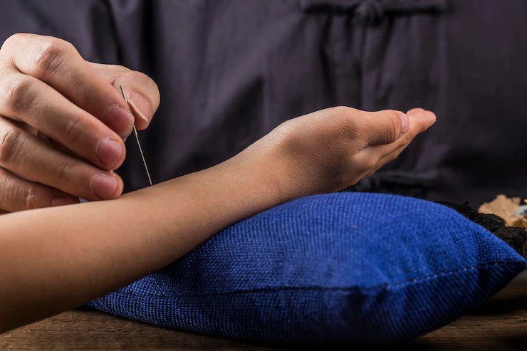 Is Acupuncture Beneficial For Women? Find Here!