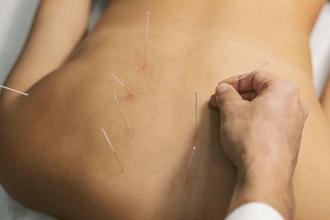 Sciatica Acupuncture