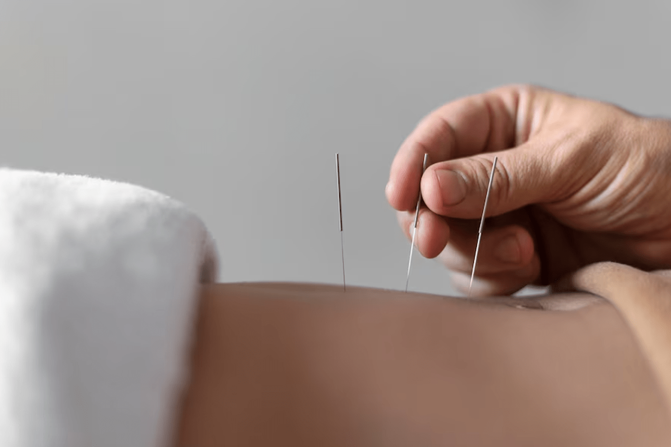 Fertility Acupuncture