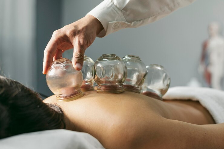 Cupping Therapy