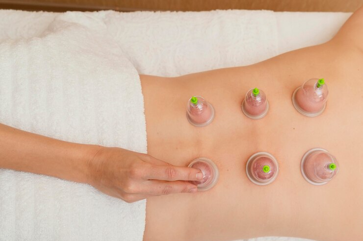 Benefits of Cupping Therapy