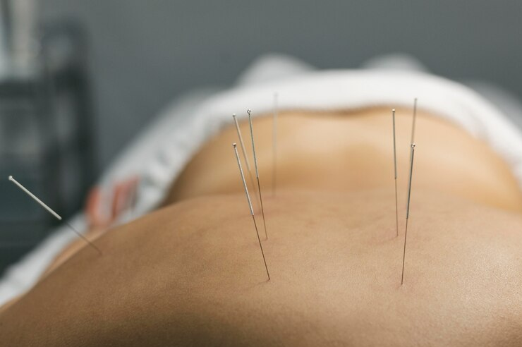 Acupuncture Treatment