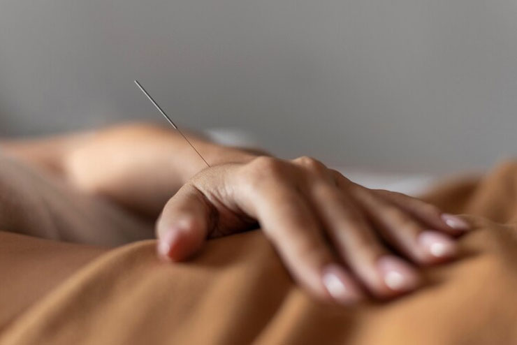 Acupuncture Treatment