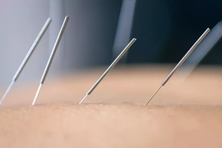 Techniques for heat acupuncture