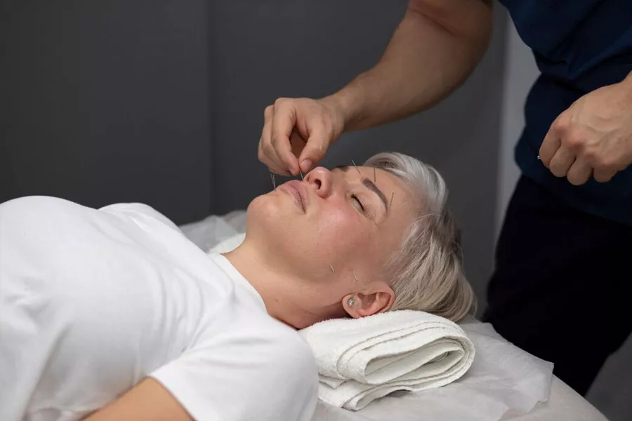 Facial Acupuncture for anti-aging
