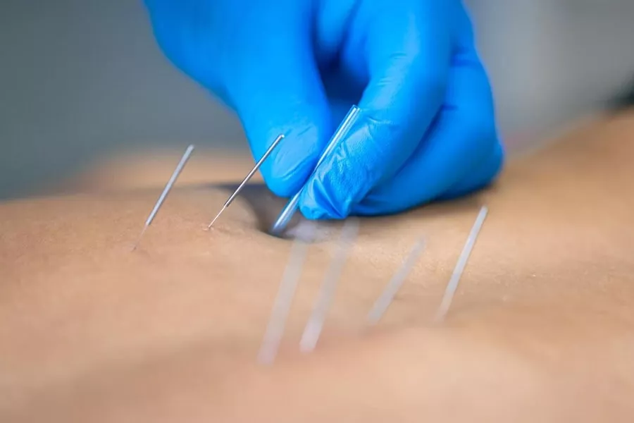 Traditional Chinese Medicine Acupuncture