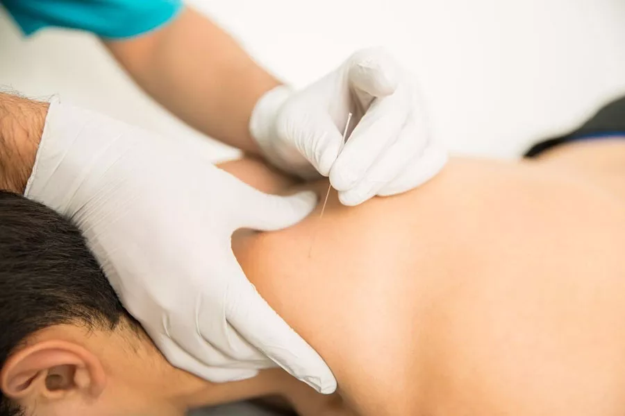 benefits of acupuncture to relieve stress