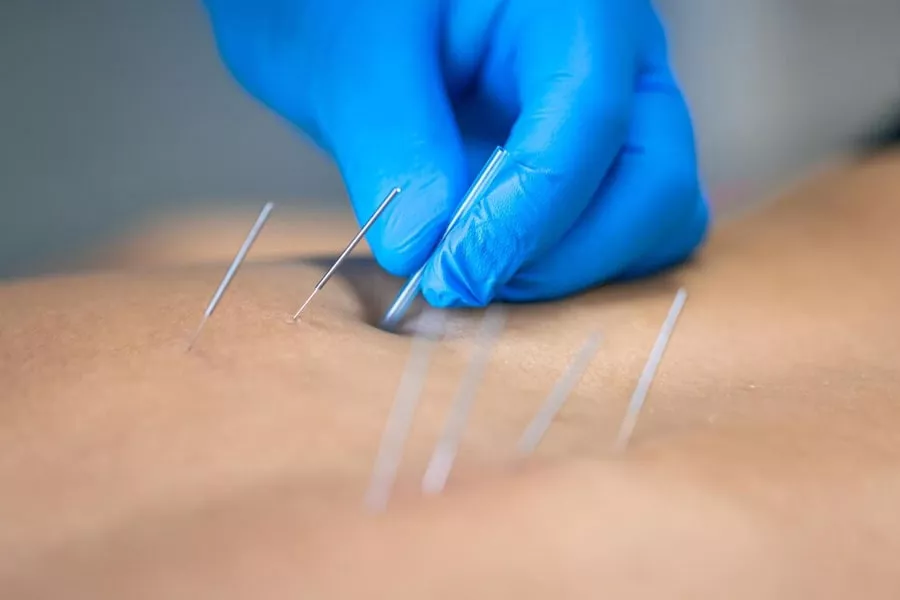 Misconceptions of Acupuncture Pain
