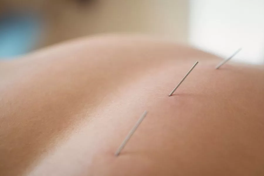 Benefits of Acupuncture