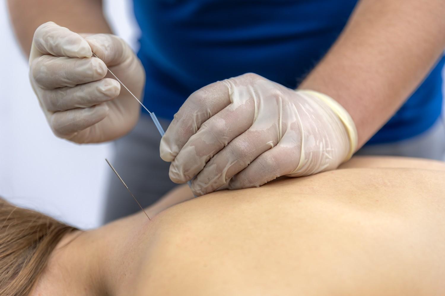 Moxibustion Supports Acupuncture