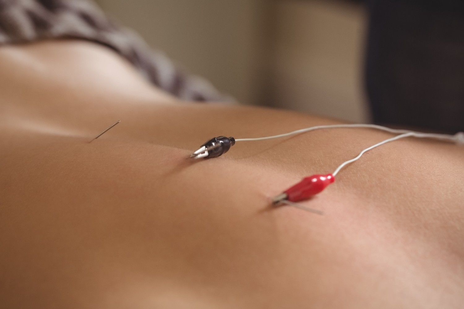 Use of Electroacupuncture