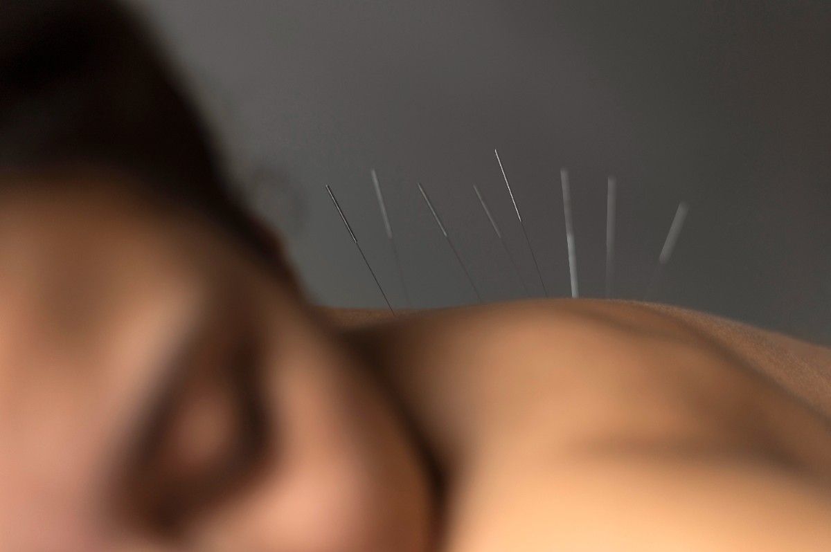 Acupuncture treatments naturally