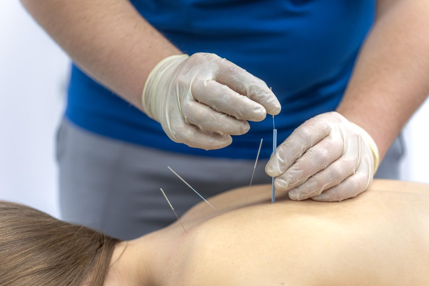back pain Acupuncture on woman